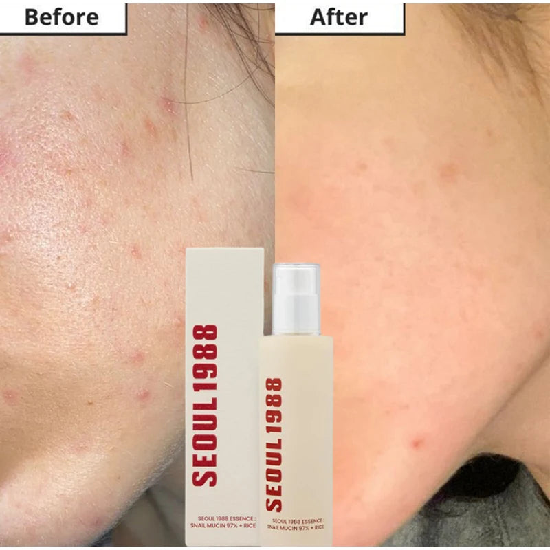 Seoul 1988 Rice Soothing Toner,Cleansing Foam,Retinol Liposome Face Cream Care Serum,Moisturizing sunscreen,Korean Skincare Set